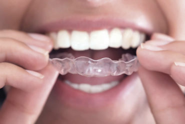 Chega de manutenção dolorosa! Conheça a tecnologia que garante o alinhamento dos dentes sem bráquetes
